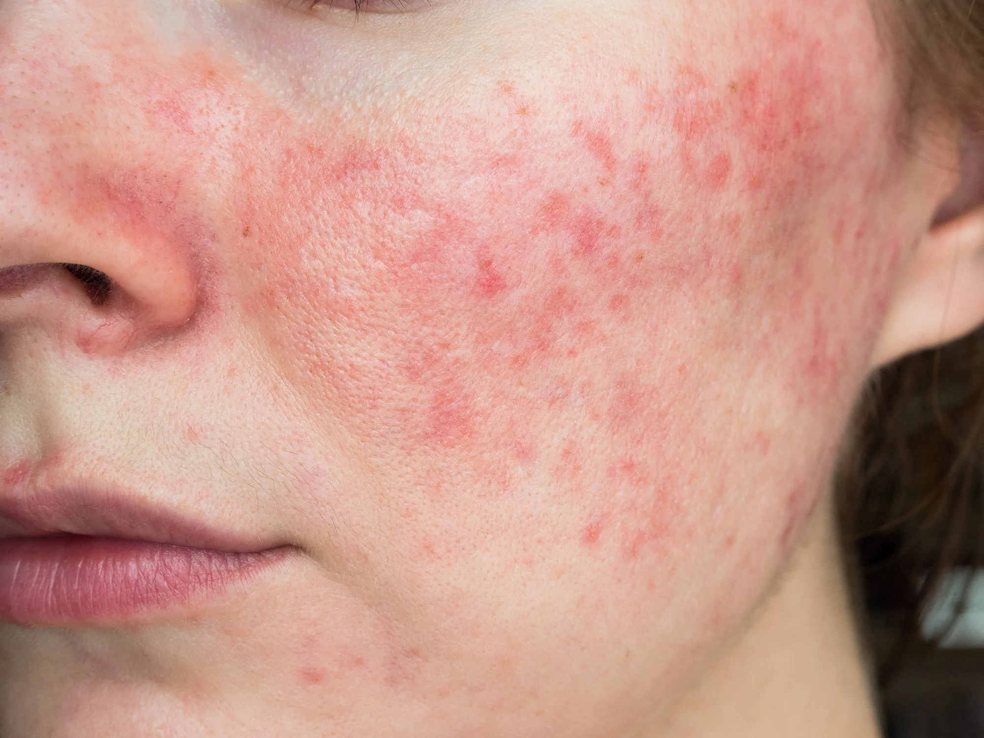 Rosacea assessment at Aesthetica