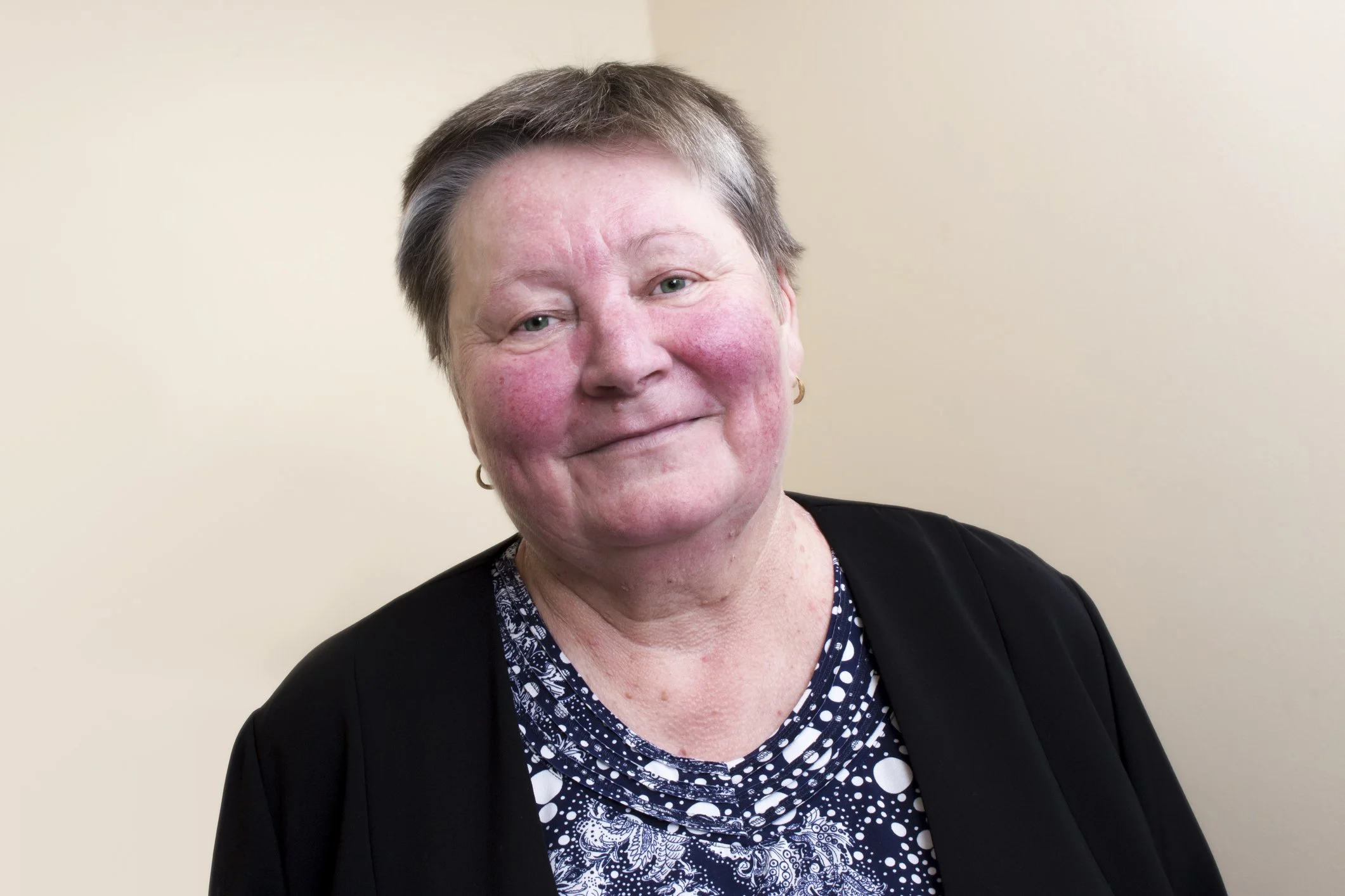 Facial redness associated with rosacea