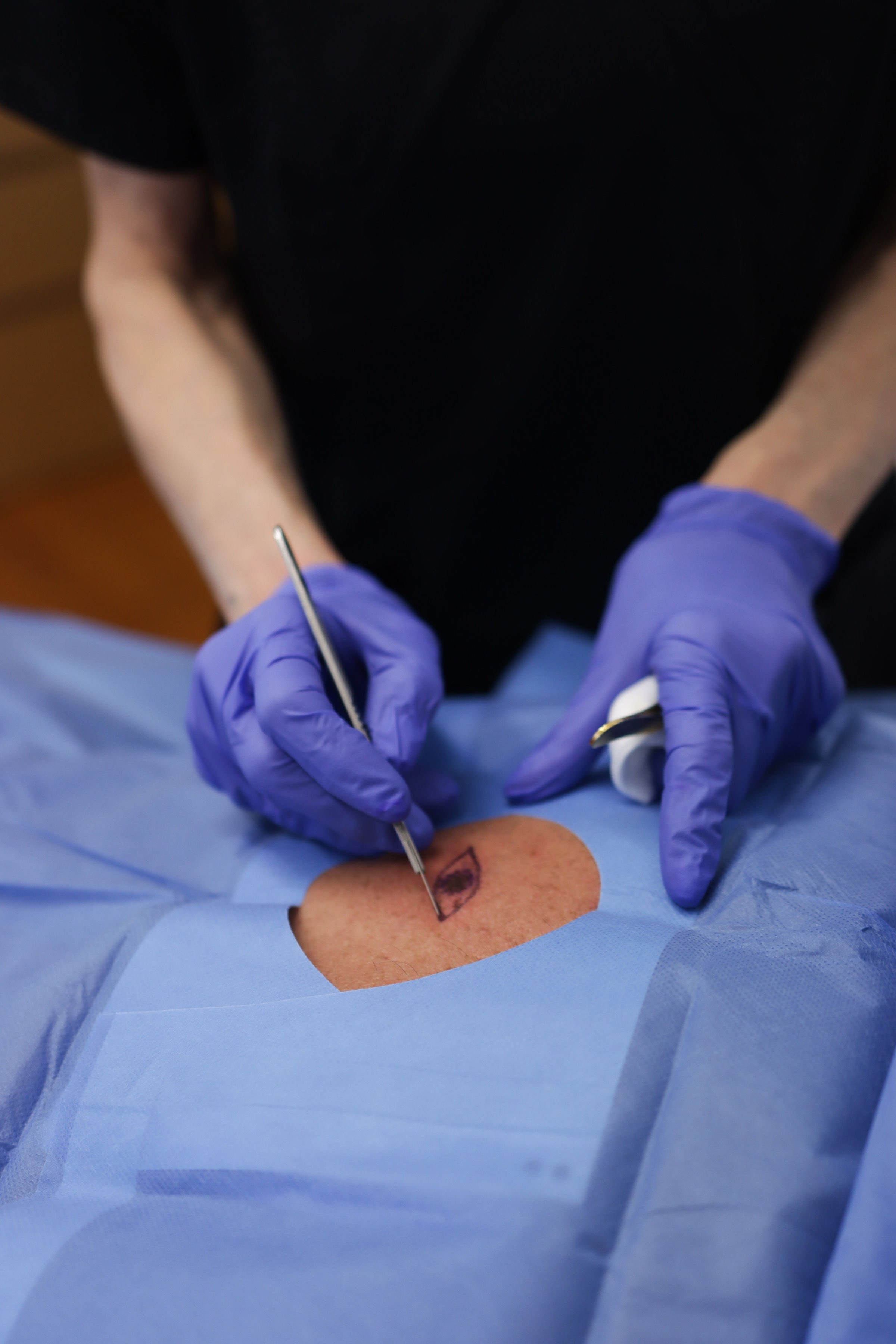 Surgical preparation for a mole excision at Aesthetica
