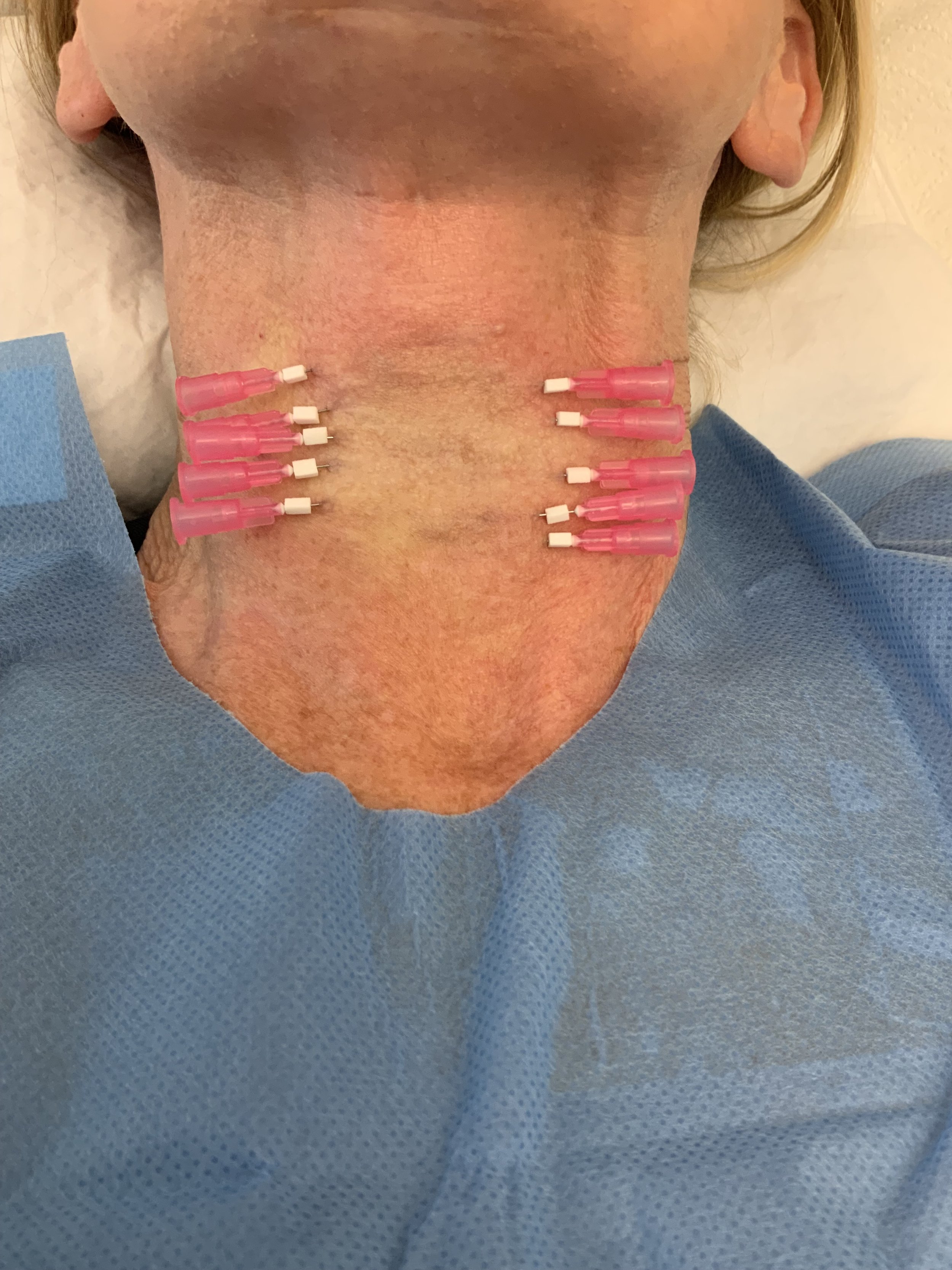 Mono threads placed in the neck at Aesthetica