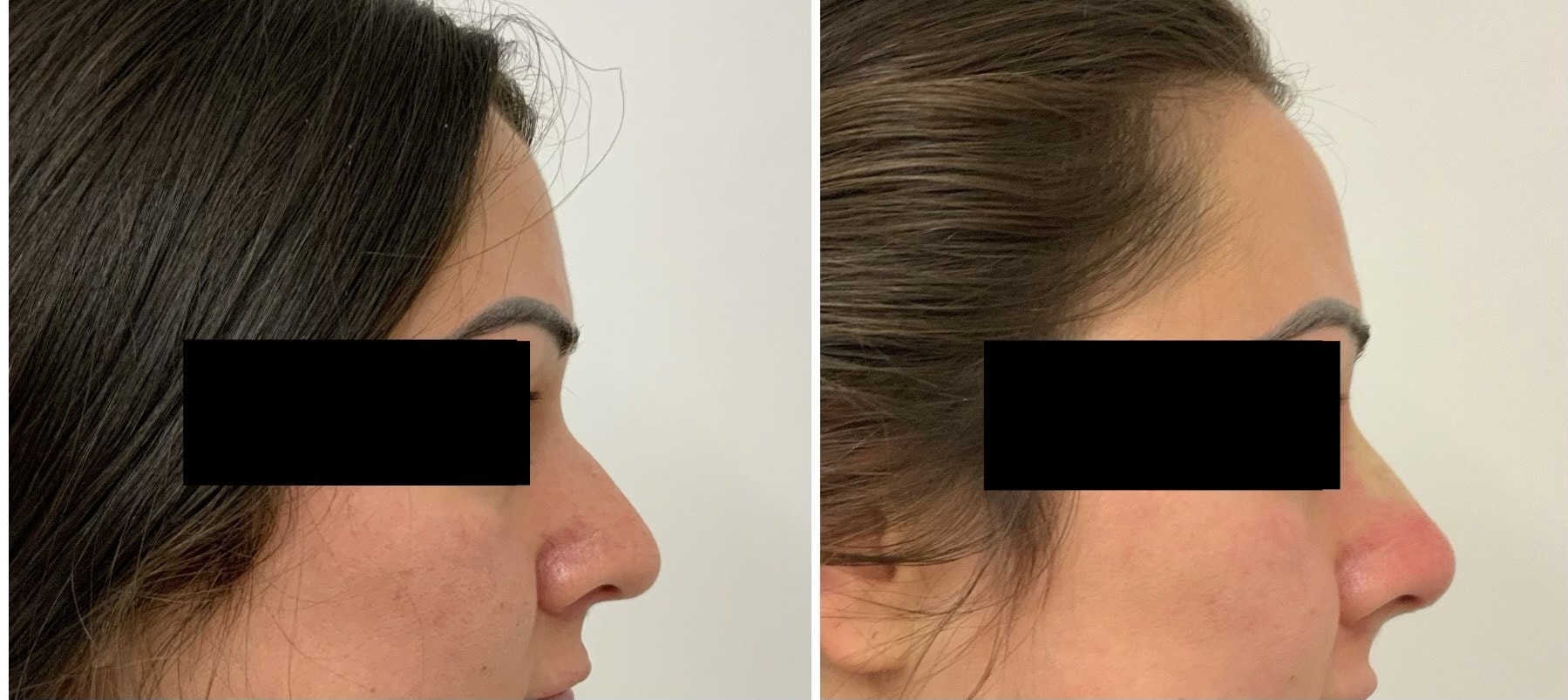 Non-surgical nose thread lift, before and after