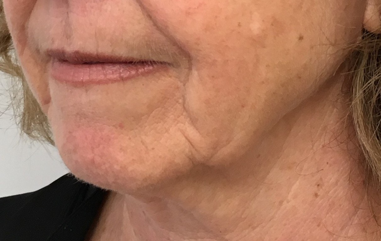 Jowls along the lower face and jawline