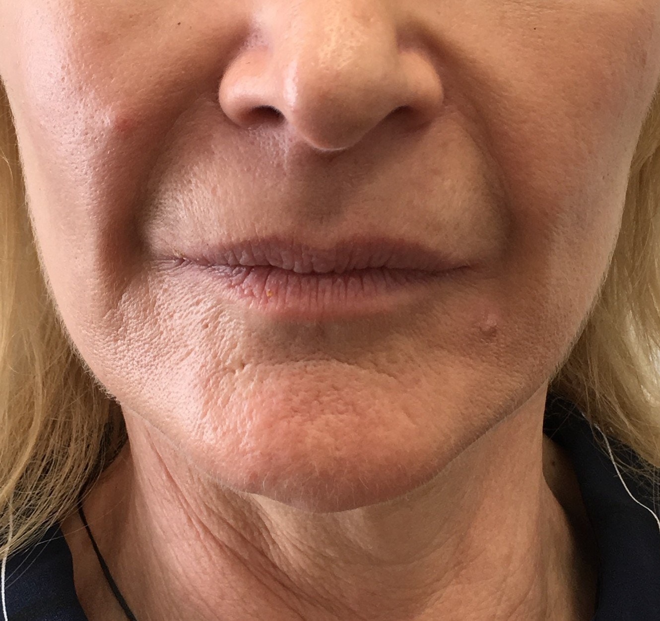 Nasolabial folds running from the nose to the corners of the mouth