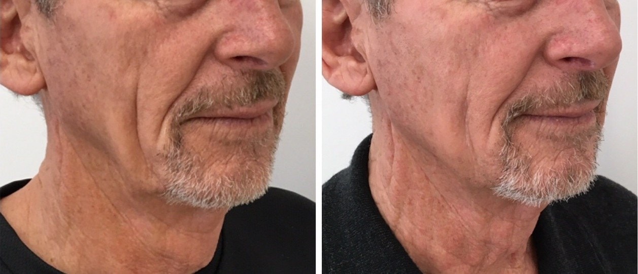 Jowls treated with dermal filler, before and after