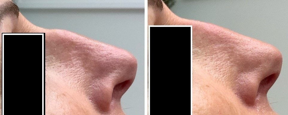 Second before and after non-surgical nose thread lift result