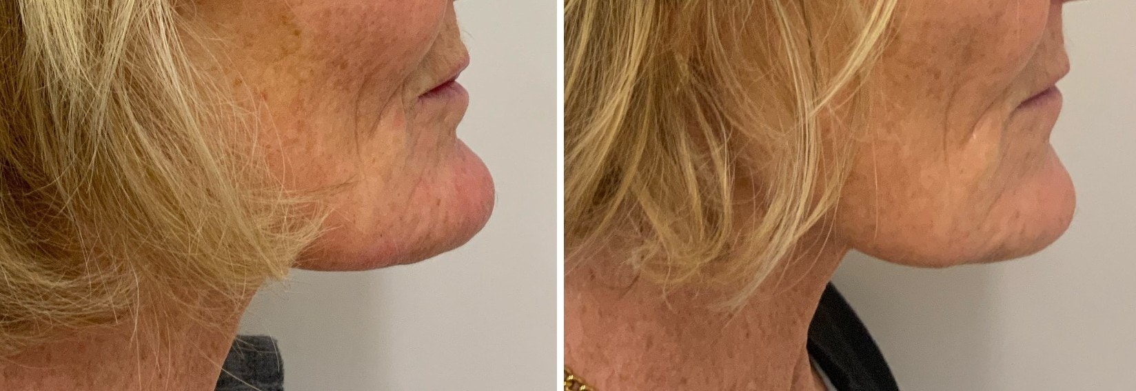 Before and after chin filler result, right side profile