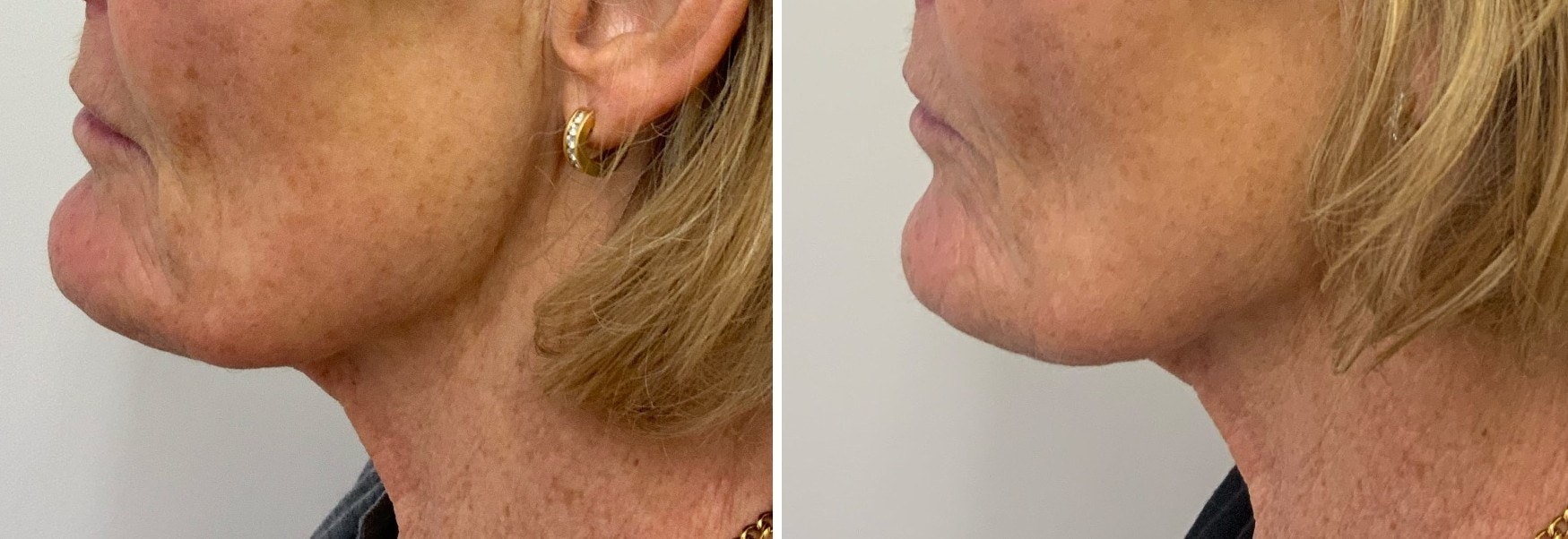 Before and after chin filler result, left side profile