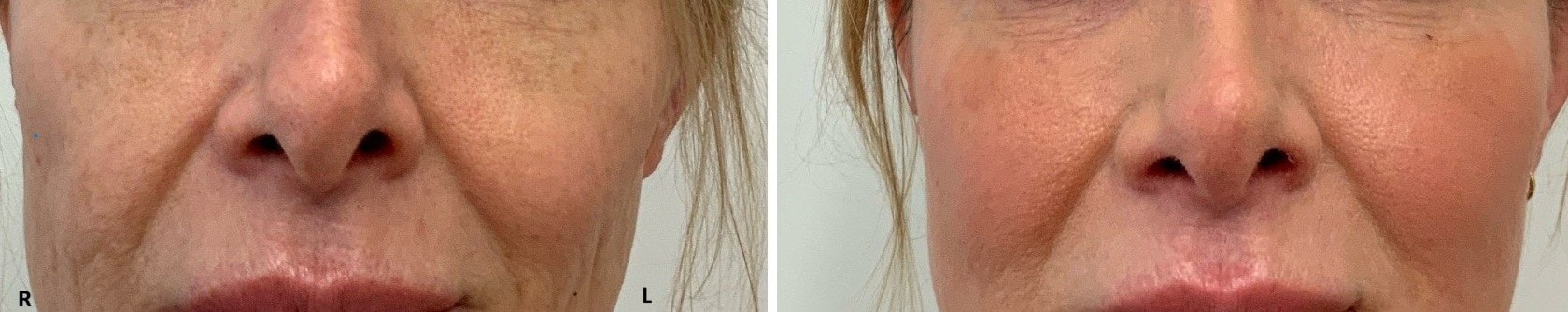 Before and after thread lift to the cheeks with filler to one cheek to correct asymmetry