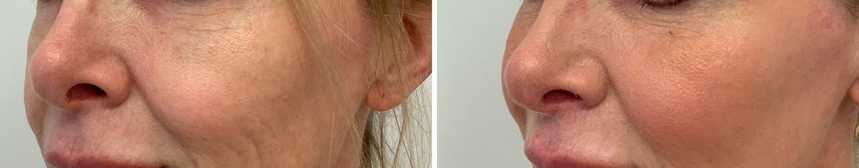 Before and after thread lift to the cheeks with filler to one cheek to correct asymmetry