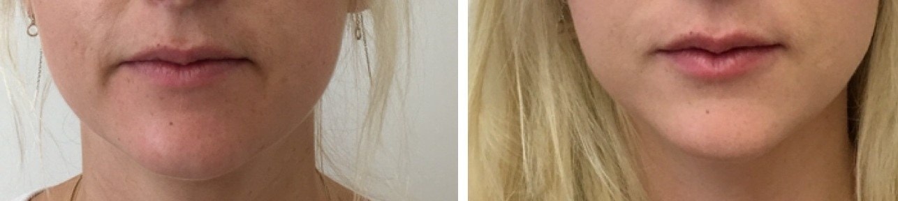 Corners of the mouth treated with anti-wrinkle injections, before and after