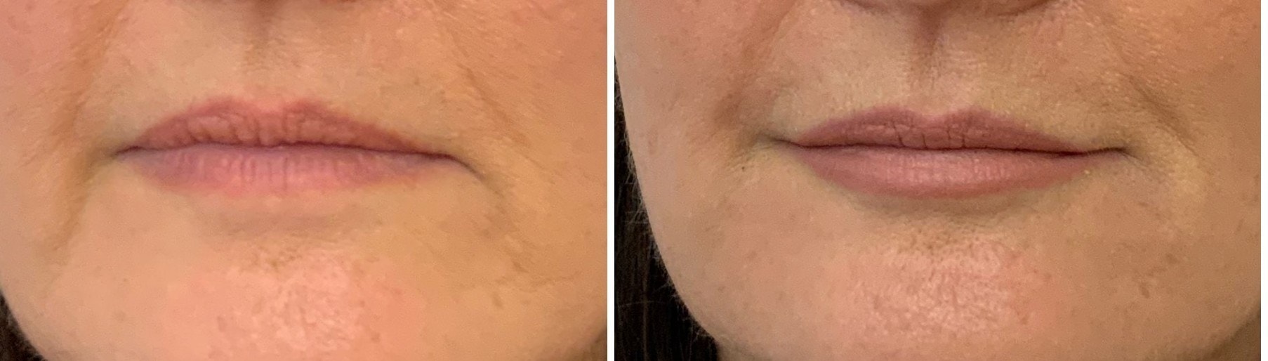 Down-turned mouth treated with dermal filler, before and after