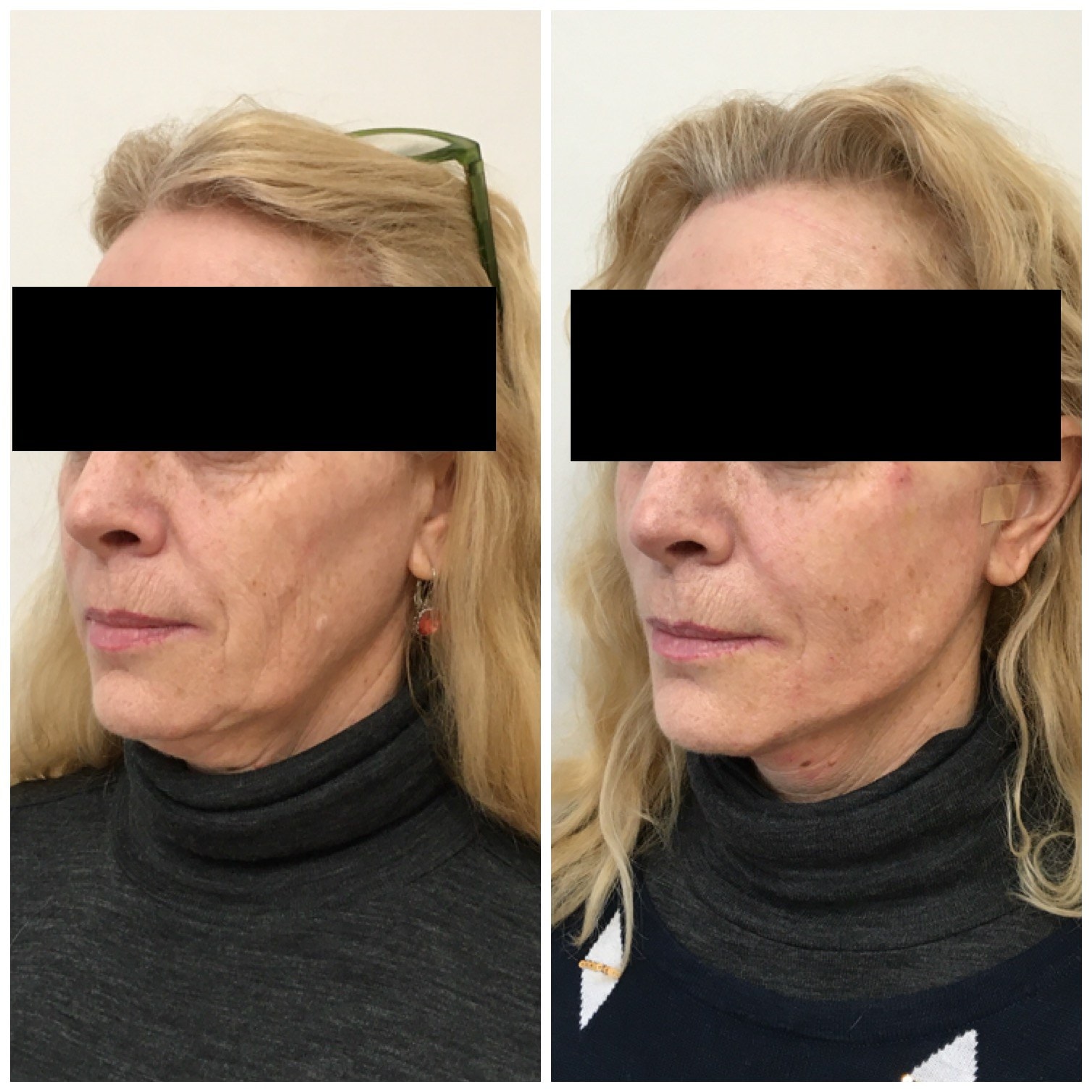 Jowls treated with a thread lift, before and after