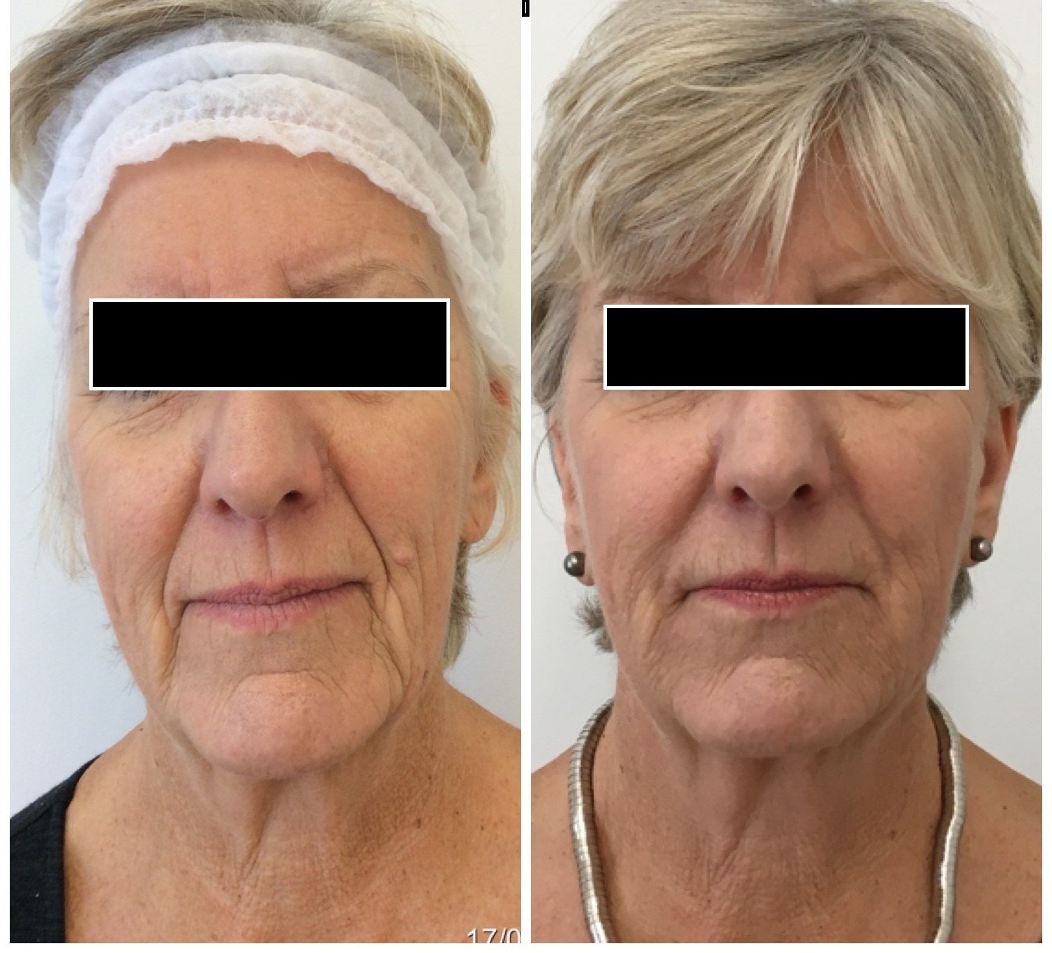 Skin firmness restored with dermal filler, before and after