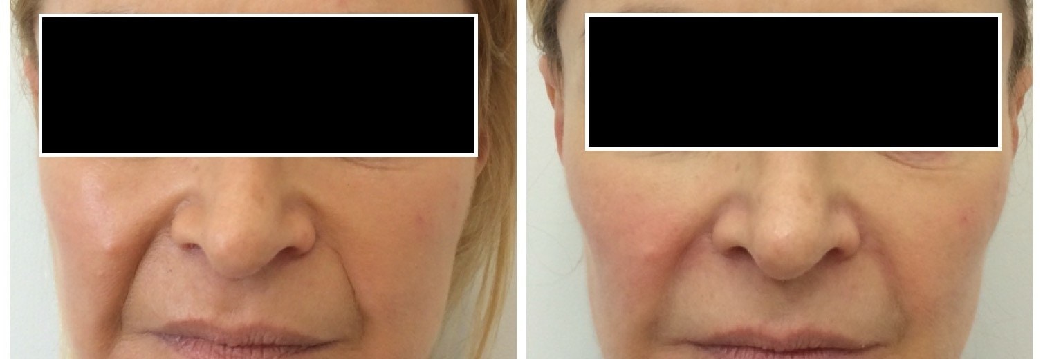 Nasolabial folds treated with dermal filler, before and after