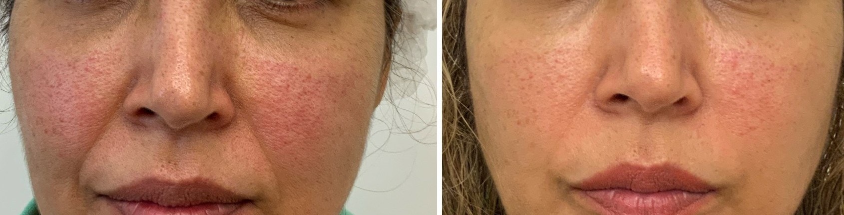 Nasolabial folds treated with a thread lift, before and after