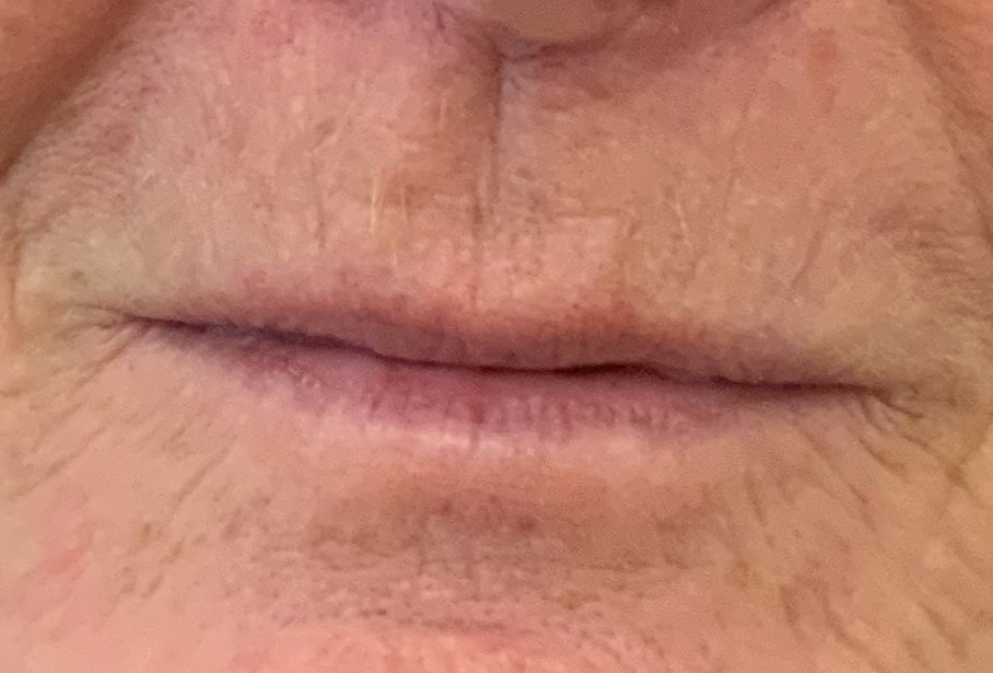 Thin lips, the concern treated with dermal filler at Aesthetica