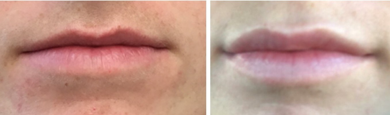 Lips treated with dermal filler, before and after