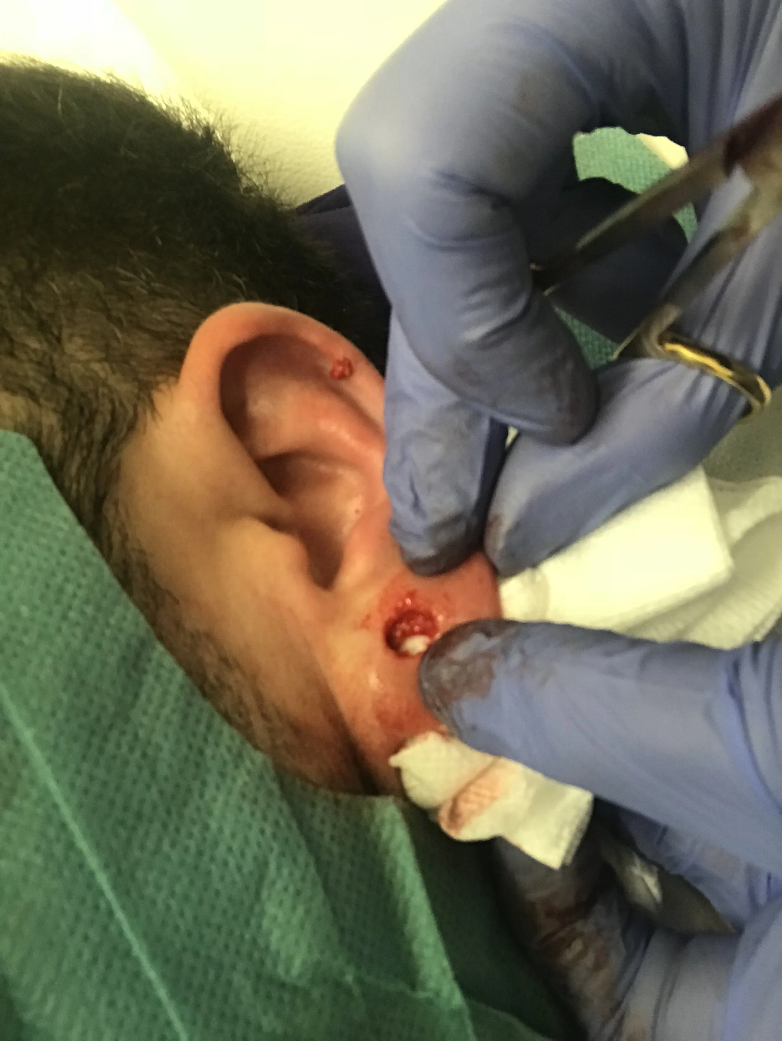 Excision of skin cells lining a stretched piercing