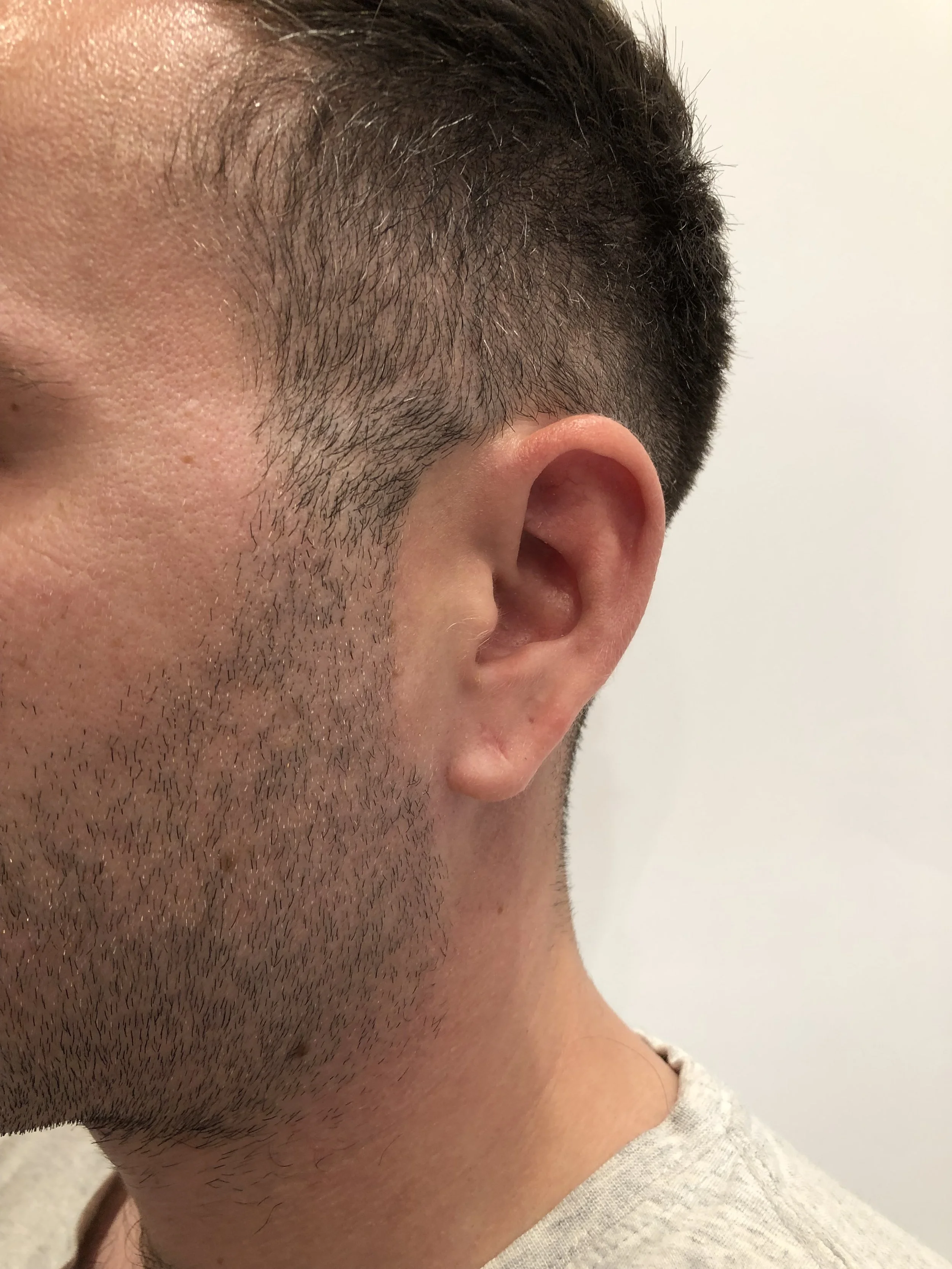 Healed result after minor surgical excision