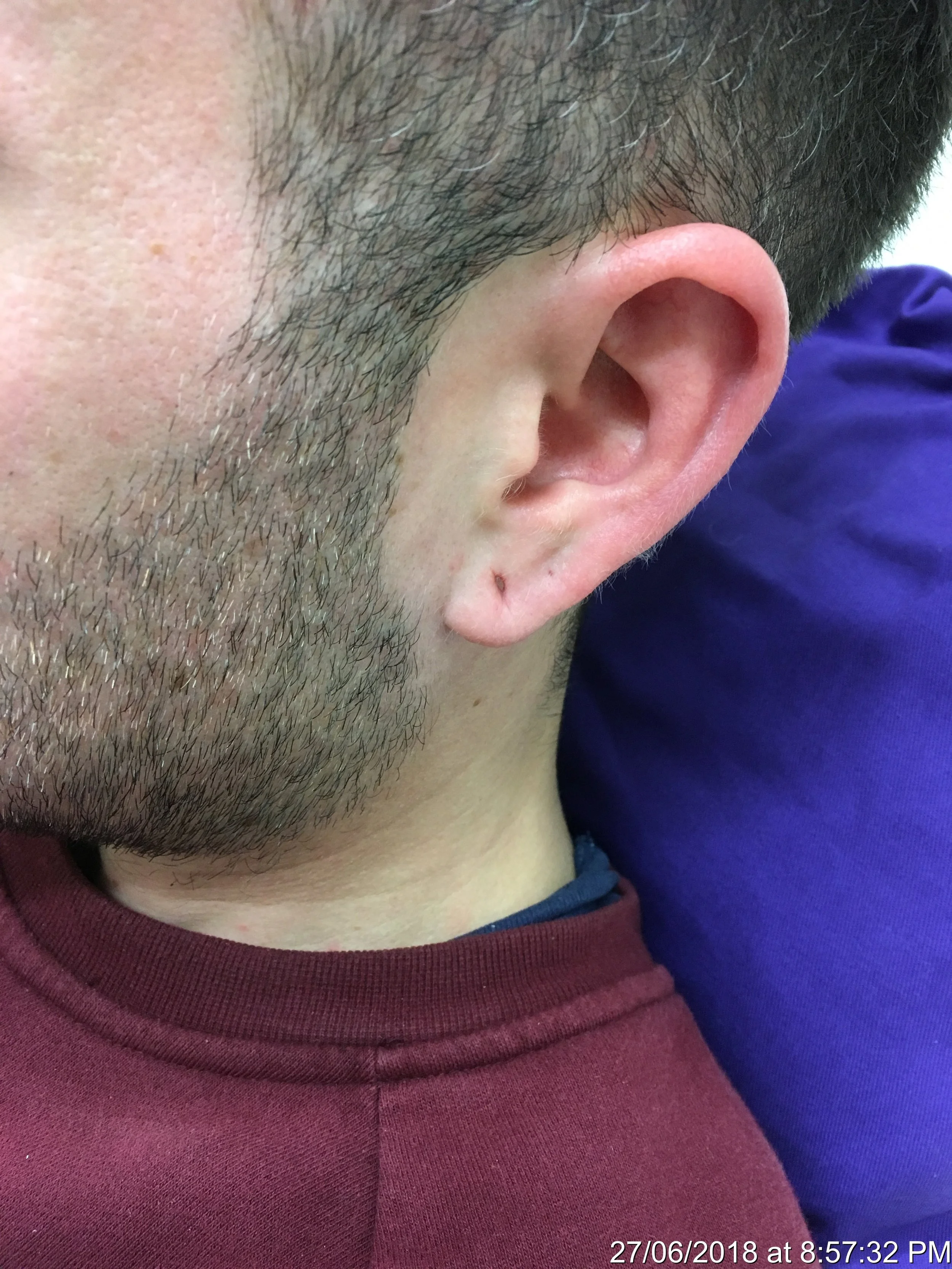 Stretched ear lobe piercing before excision