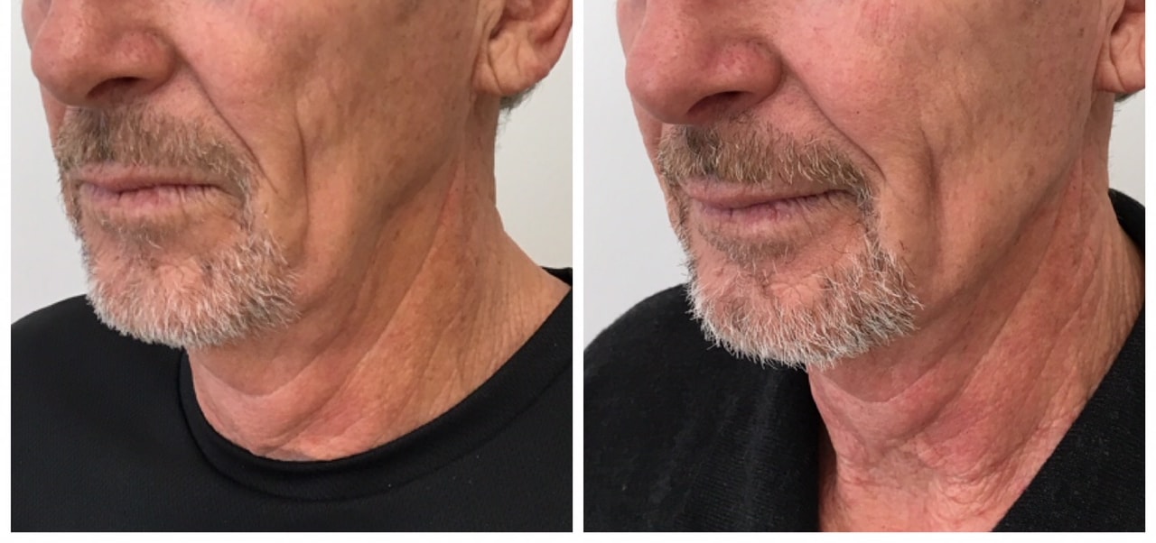 Jawline dermal filler result