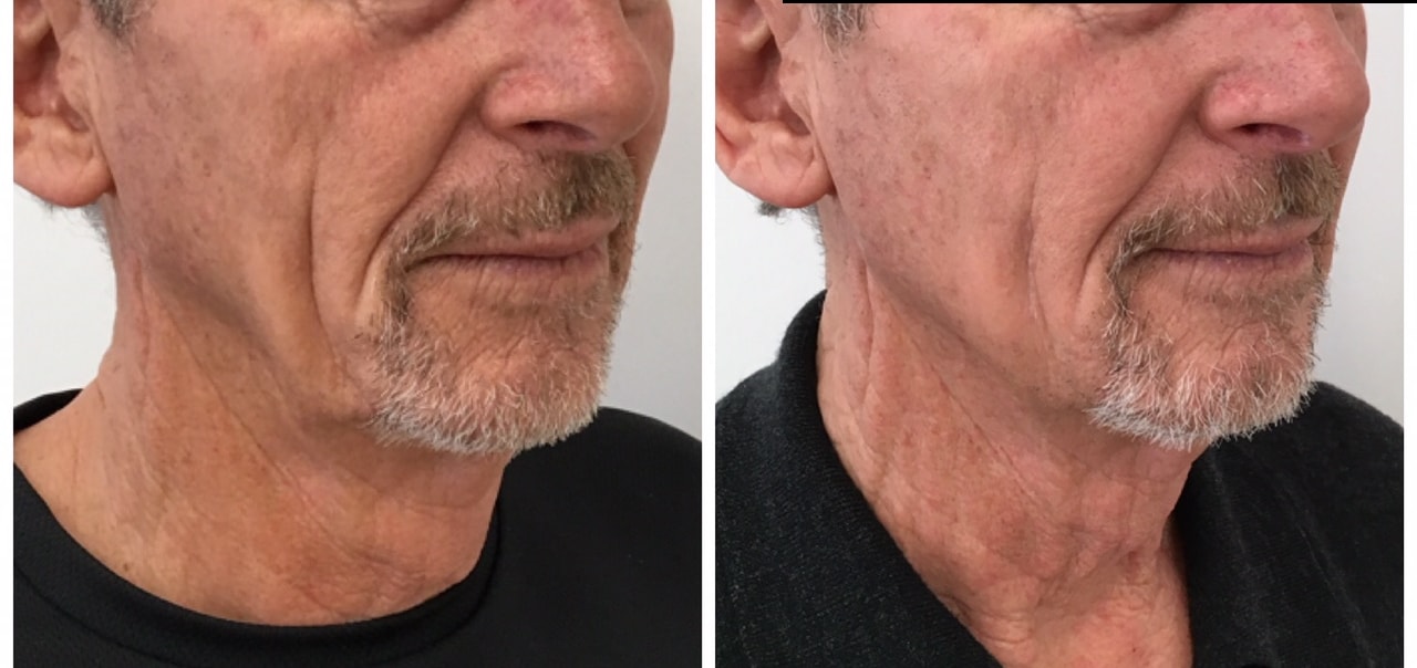 Jawline dermal filler result