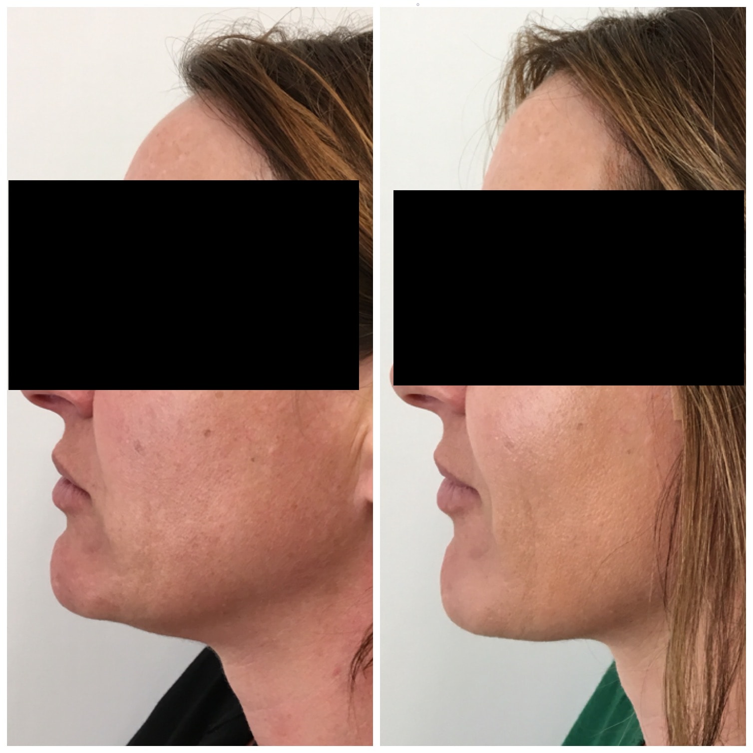 Thread lift to cheeks and jowls