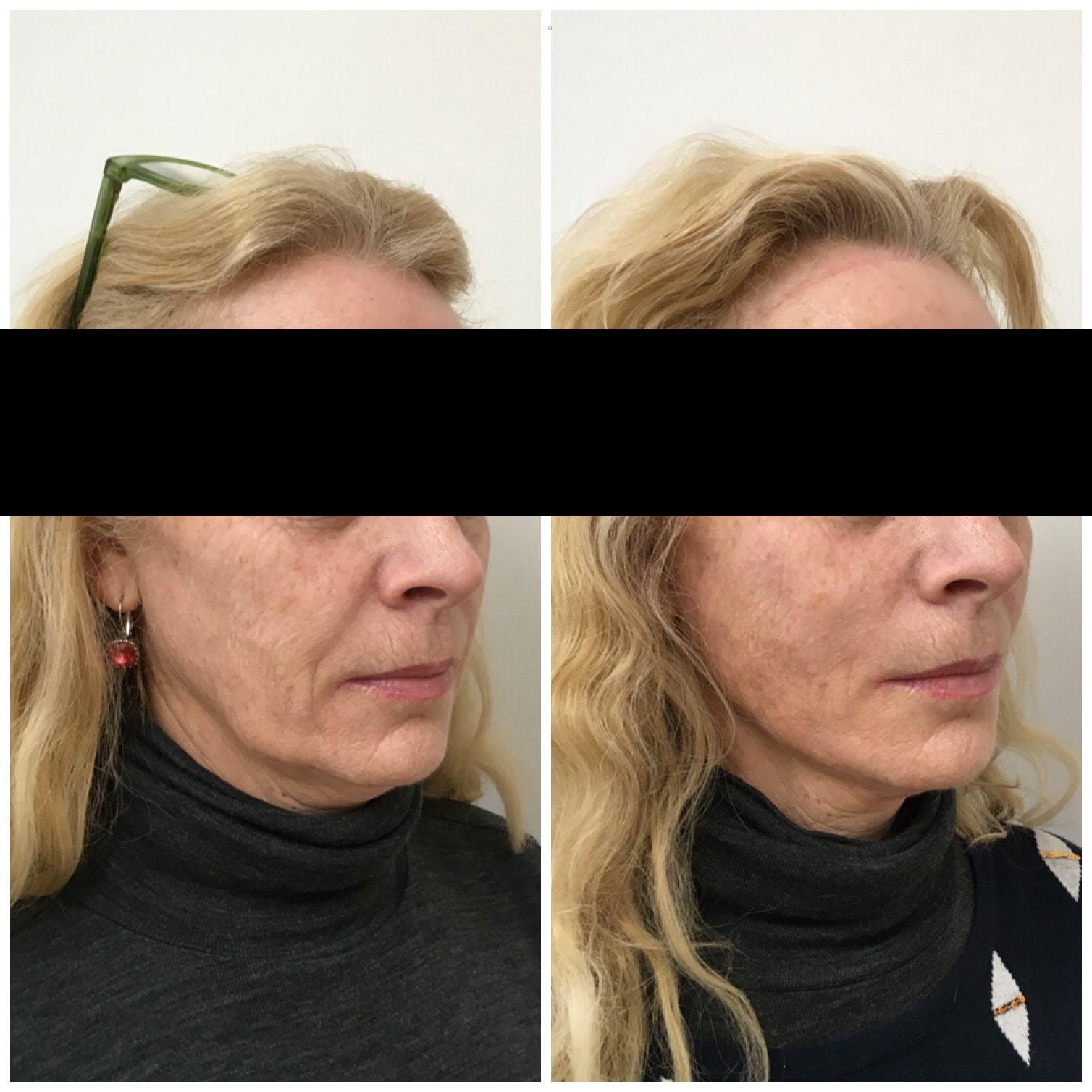Thread lift to cheeks, jowls and neck