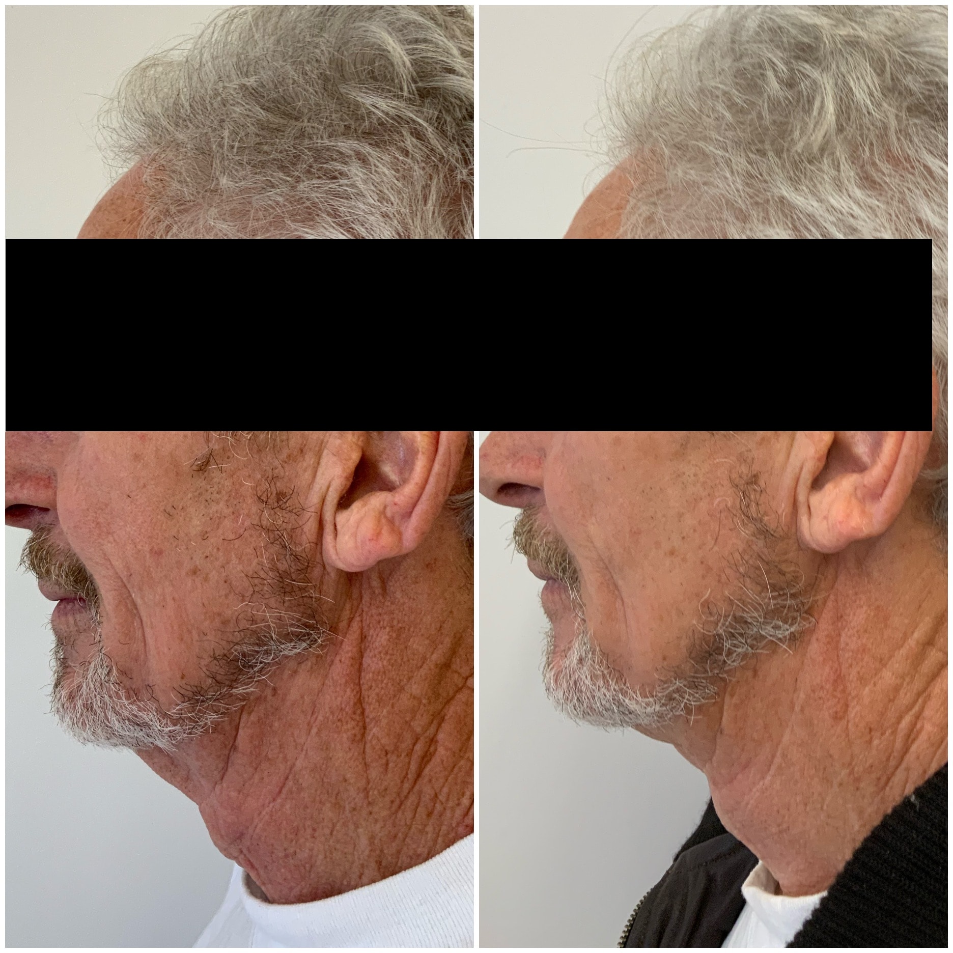 Thread lift to neck