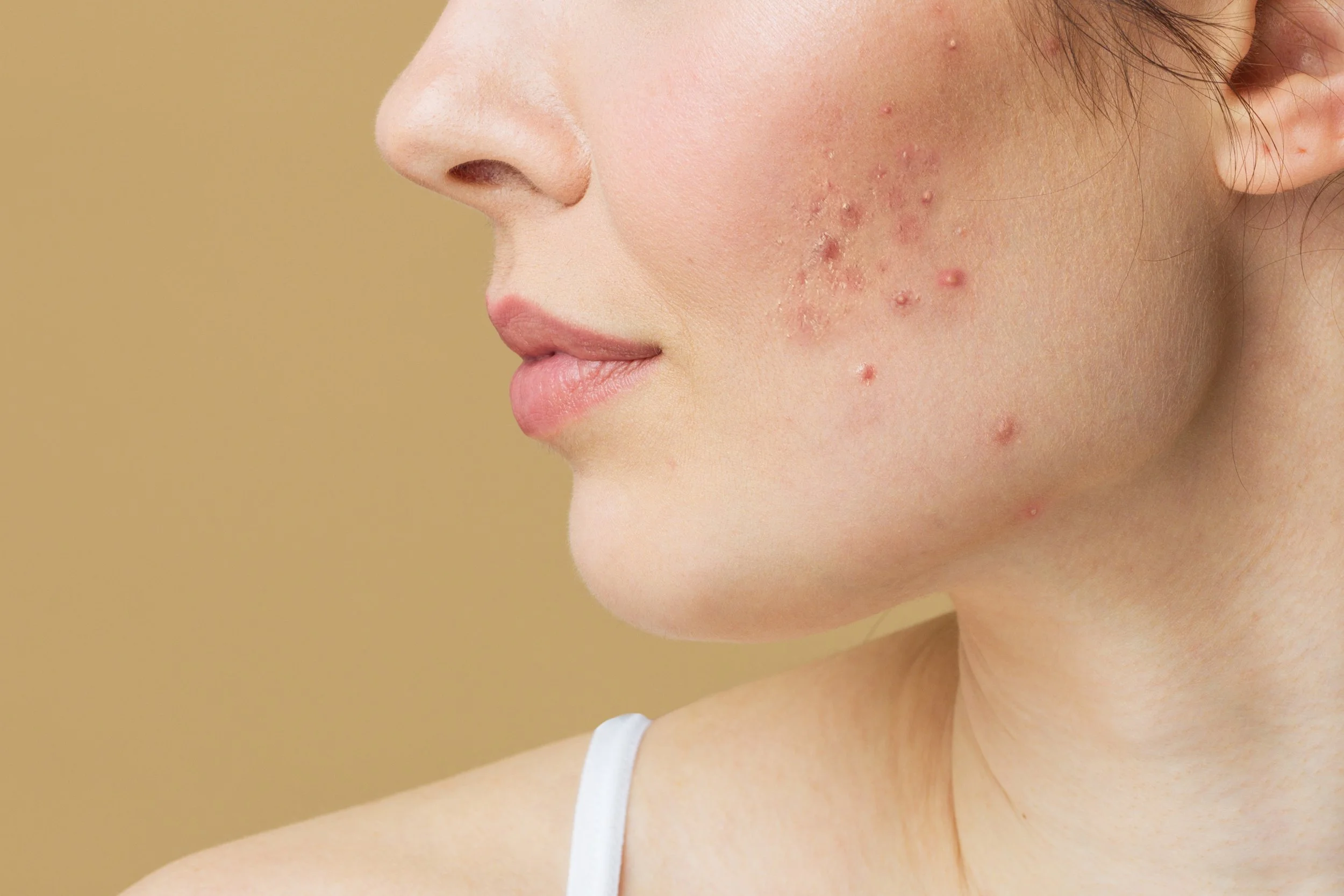 Medical dermal needling for acne scarring