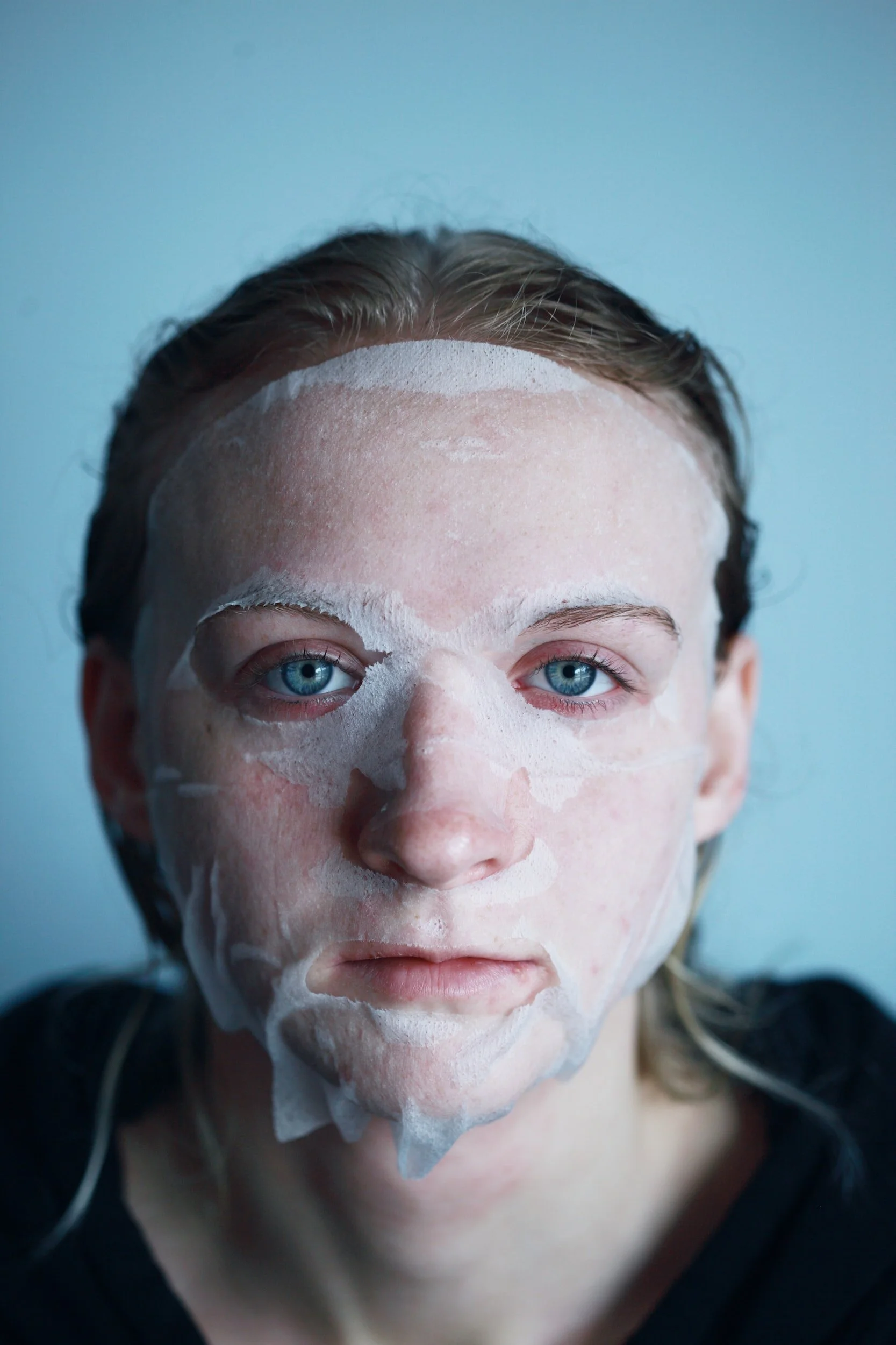 Young woman with acne which may lead to acne scarring