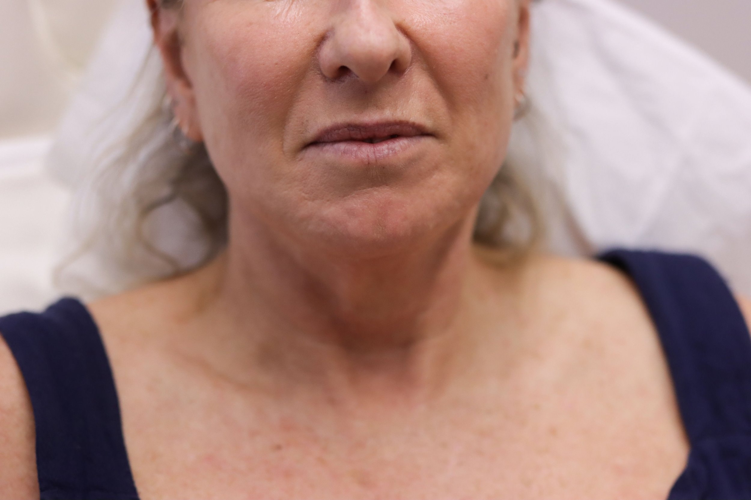 Dr Patti Piper performing a thread treatment