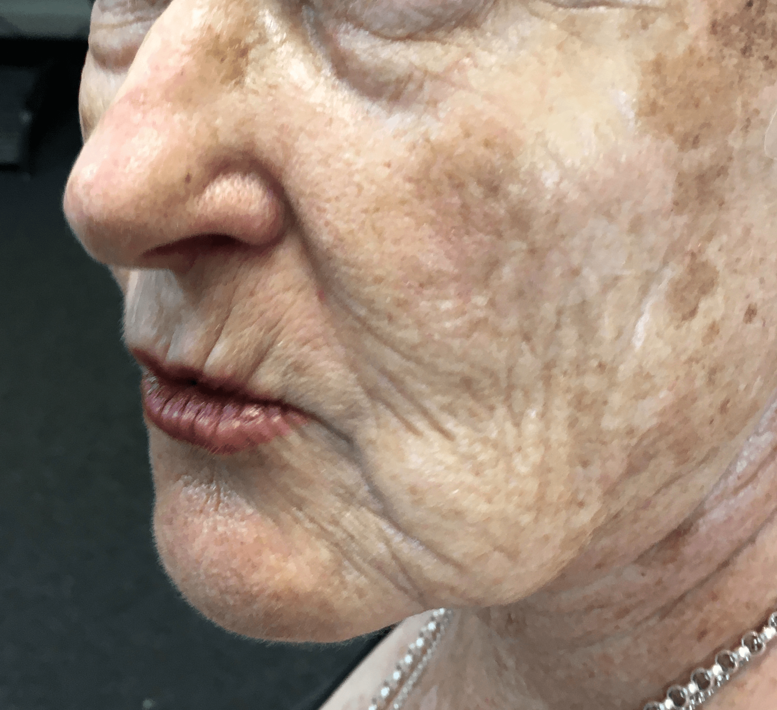 Skin pigmentation and uneven tone