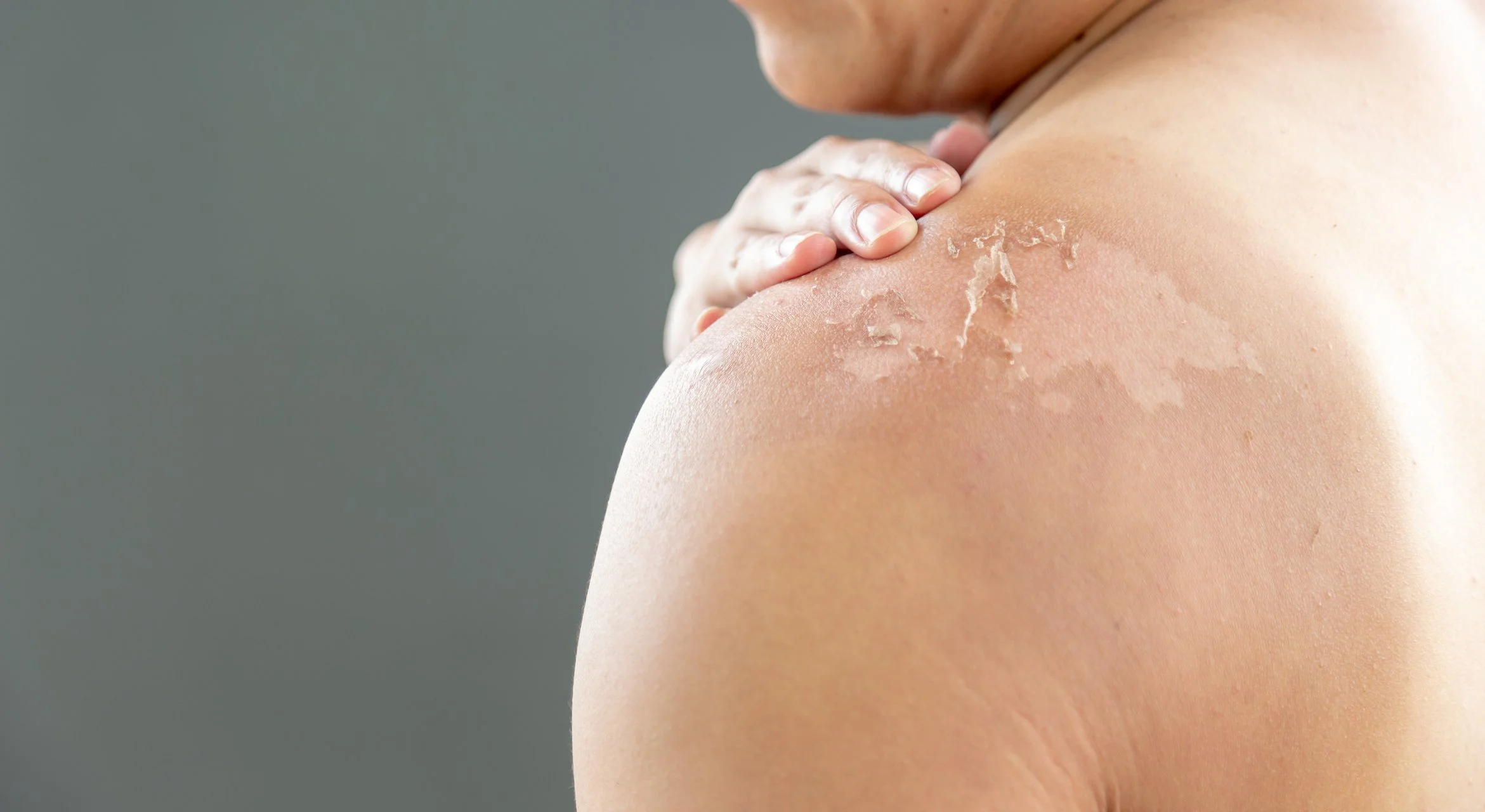 Sun damaged skin